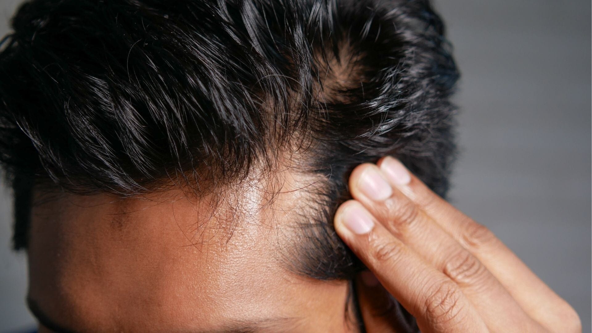 Queda de cabelo nos homens: porque muitos procuram informação sobre Minoxidil e alternativas naturais